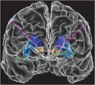 Artifact characterization and mitigation techniques during concurrent sensing and stimulation using bidirectional deep brain stimulation platforms